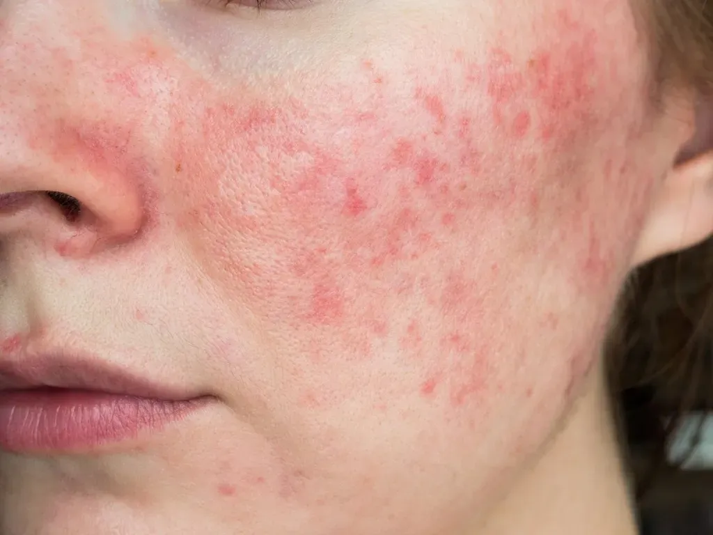 Stop Doing These 3 Things If You Have Rosacea