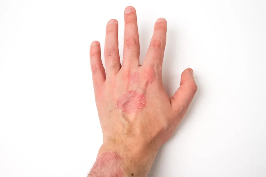 At-Home Remedies for Reducing Eczema Triggers