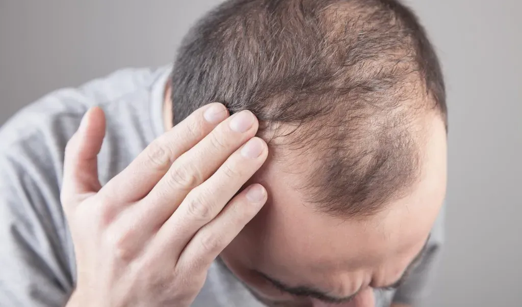 How Does Laser Therapy Treat Hair Loss?