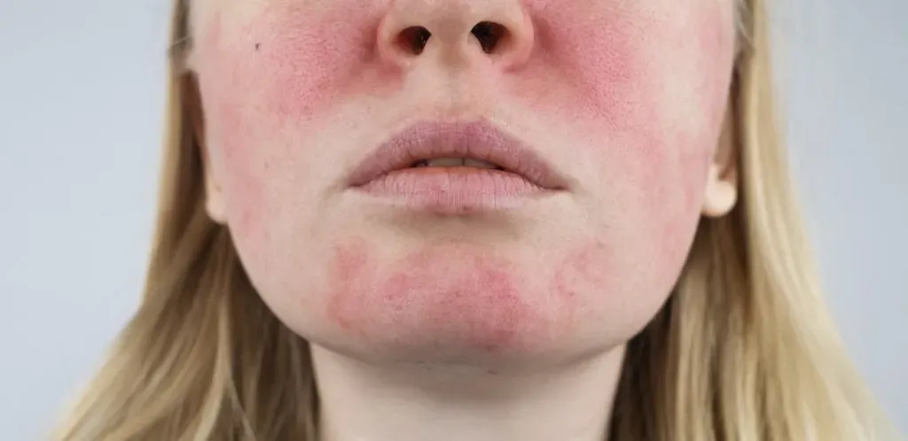 Does Rosacea Ever Go Away?