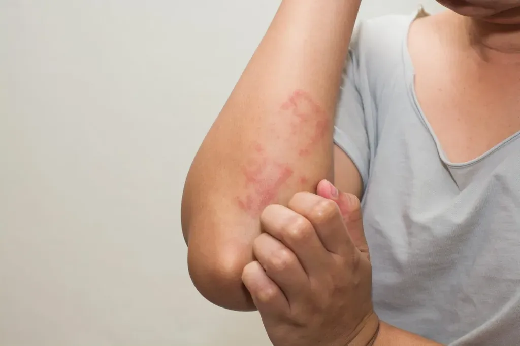 Can You Develop Eczema Later in Life?