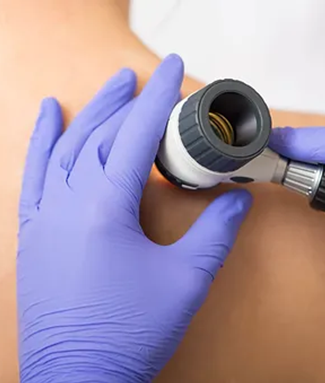 Skin Cancer Screening