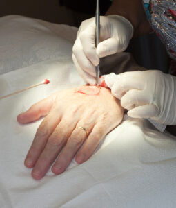 Patient receiving skin cancer treatment Washington DC with Mohs surgery at 19th Street Dermatology