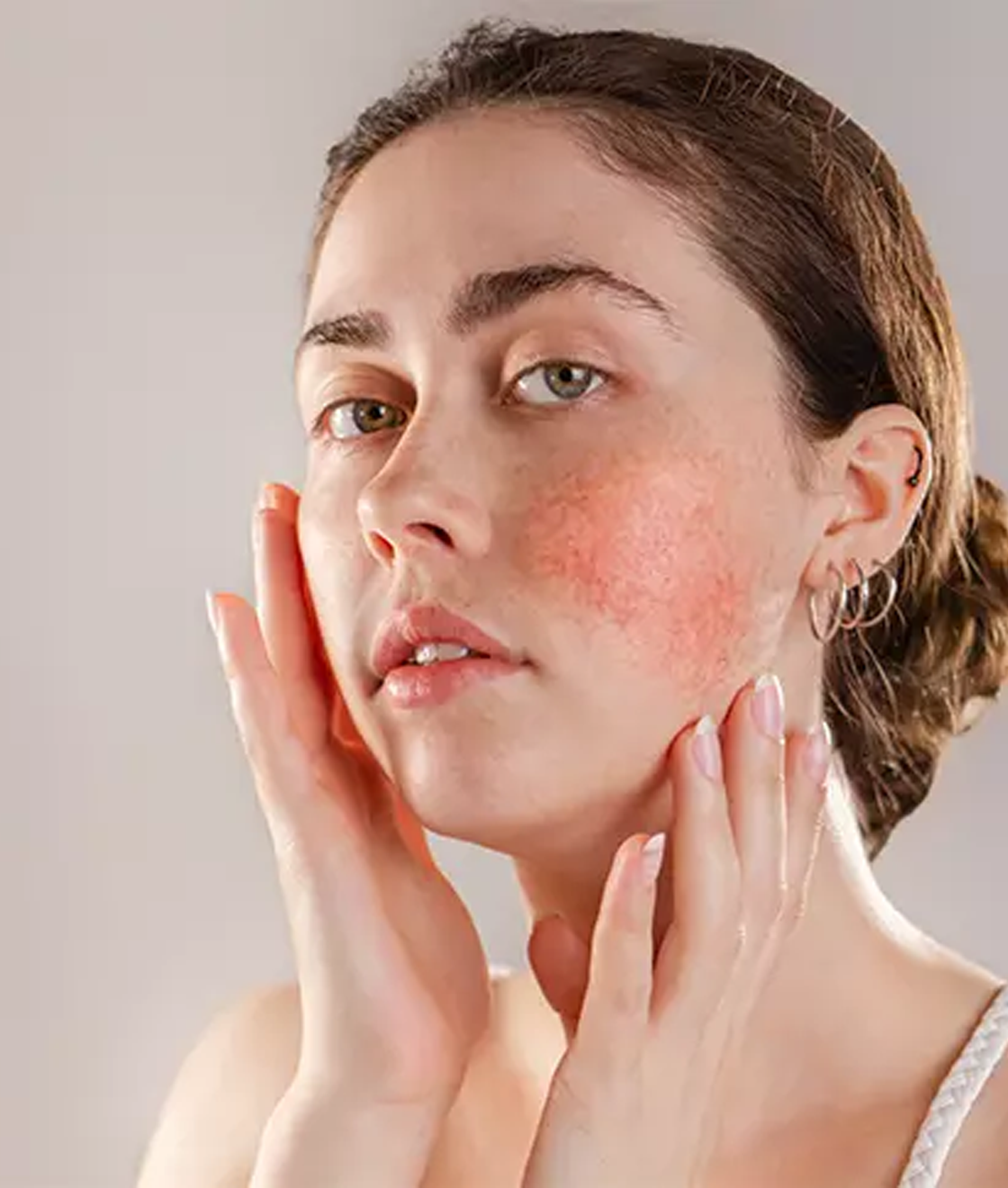 Rosacea