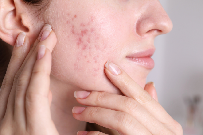 Rosacea Remedies to the Rescue: Rosacea Treatment in Washington, DC