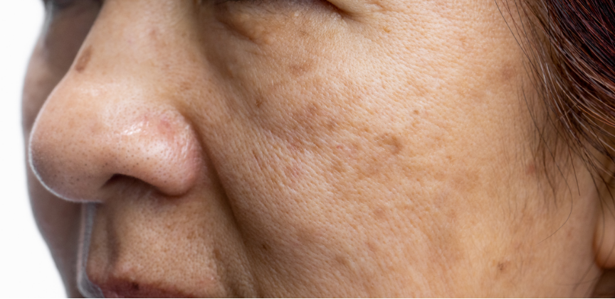 Say Goodbye to Dark Spots: Your Guide to Dark Spot Laser Removal in DC