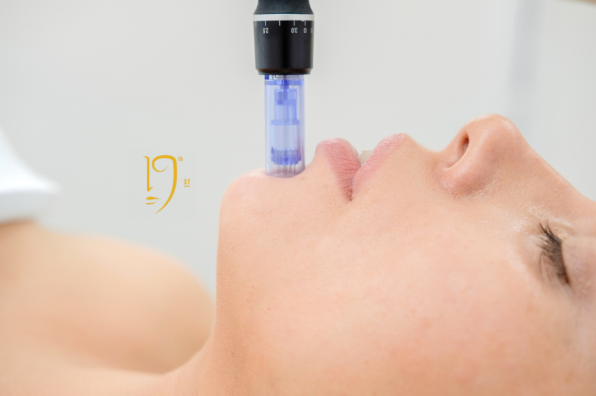 Close-up of a patient receiving RF microneedling with PRP in Washington, DC, on the chin at a dermatology practice to stimulate collagen and improve skin texture.