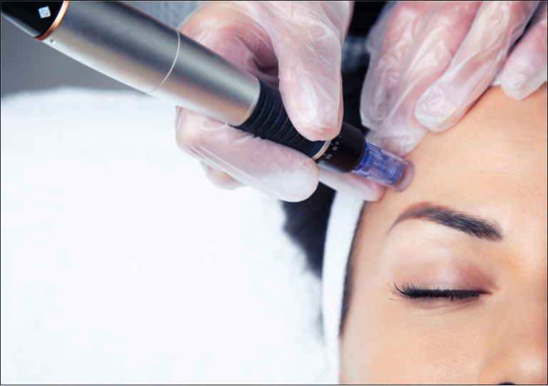 Board-certified dermatologist performing radiofrequency microneedling treatment in Washington, DC, to improve skin texture, acne scars, and collagen production.