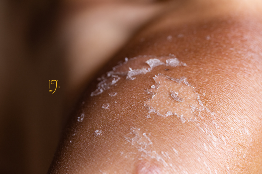Sun-damaged skin with peeling and hyperpigmentation, a concern treated by the best dermatologist near Arlington